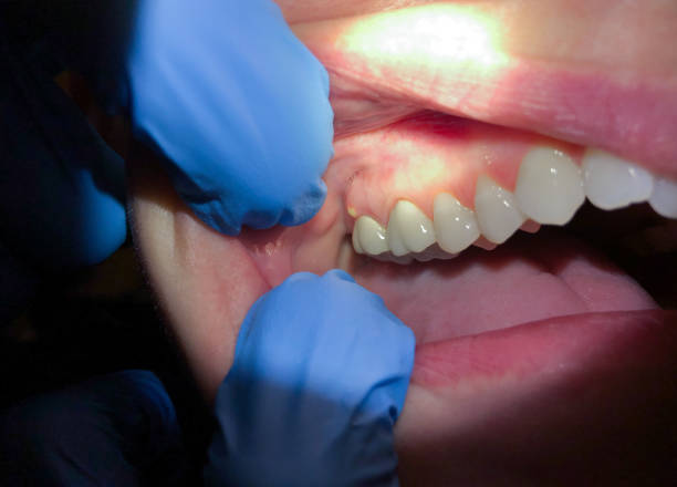 Best Emergency Gum Treatment in Ava, MO